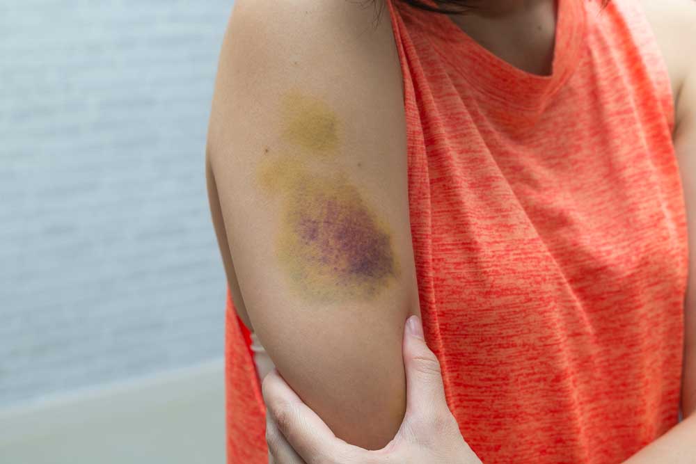 bruise